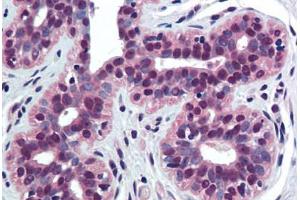 Human Breast (formalin-fixed, paraffin-embedded) stained with TNFRSF10B antibody ABIN290834 at 10 ug/ml followed by biotinylated goat anti-rabbit IgG secondary antibody ABIN481713, alkaline phosphatase-streptavidin and chromogen. (TNFRSF10B Antikörper  (AA 388-407))