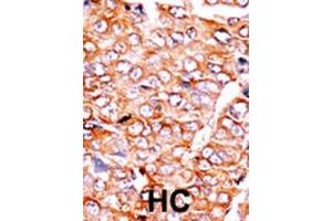 Formalin-fixed and paraffin-embedded human cancer tissue reacted with the primary antibody, which was peroxidase-conjugated to the secondary antibody, followed by AEC staining. (BID Antikörper  (pSer65))