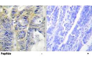 Immunohistochemistry analysis of paraffin-embedded human colon carcinoma tissue using COL4A5 polyclonal antibody . (COL4a5 Antikörper)
