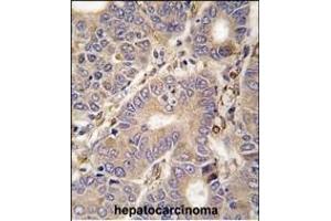 Formalin-fixed and paraffin-embedded human hepatocarcinoma tissue reacted with CARS2 antibody (C-term) (ABIN392315 and ABIN2841965) , which was peroxidase-conjugated to the secondary antibody, followed by DAB staining. (CARS2 Antikörper  (C-Term))