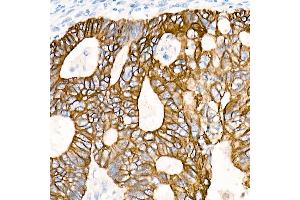 Immunohistochemistry of paraffin-embedded Human colon carcinoma using Cytokeratin 19 (KRT19) antibody (ABIN7268099) at dilution of 1:100 (40x lens). (Cytokeratin 19 Antikörper)