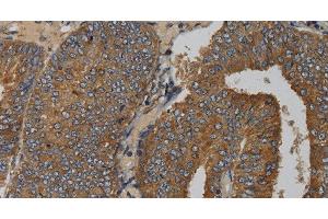 Immunohistochemistry of paraffin-embedded Human colon cancer tissue using MAS1 Polyclonal Antibody at dilution 1:50 (MAS1 Antikörper)