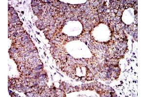Immunohistochemical analysis of paraffin-embedded rectum cancer tissues using SOD2 mouse mAb with DAB staining. (SOD2 Antikörper  (AA 1-222))