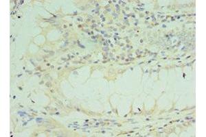 Immunohistochemistry of paraffin-embedded human colon cancer using ABIN7172205 at dilution of 1:100 (TICAM2 Antikörper  (AA 1-235))