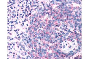Anti-OR2A4 antibody IHC of human Skin, Melanoma. (OR2A4 Antikörper  (Extracellular Domain))