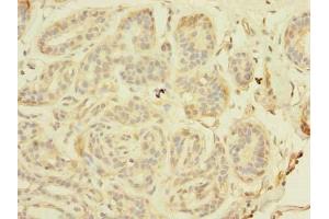 Immunohistochemistry of paraffin-embedded human breast cancer using ABIN7171326 at dilution of 1:100 (TAGAP Antikörper  (AA 97-260))