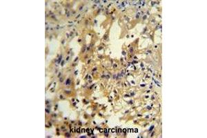UPP2 antibody (C-term) immunohistochemistry analysis in formalin fixed and paraffin embedded human kidney carcinoma followed by peroxidase conjugation of the secondary antibody and DAB staining.