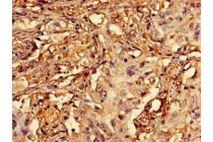 Immunohistochemistry of paraffin-embedded human lung cancer using ABIN7167421 at dilution of 1:100 (RCBTB2 Antikörper  (AA 1-200))