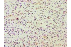 Immunohistochemistry of paraffin-embedded human breast cancer using ABIN7164363 at dilution of 1:100 (DDX5 Antikörper  (AA 1-290))