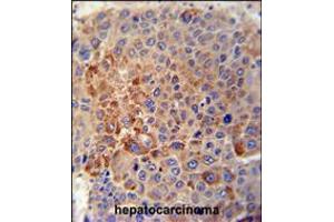 GPLD1 Antibody immunohistochemistry analysis in formalin fixed and paraffin embedded human hepatocarcinoma tissue followed by peroxidase conjugation of the secondary antibody and DAB staining. (GPLD1 Antikörper  (C-Term))