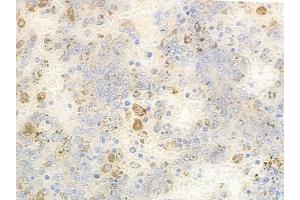 ABIN6259823 and ABIN6278749 at 1/100 staining human melanoma by IHC-P.