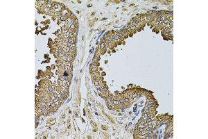 Immunohistochemistry of paraffin-embedded human prostate using MTIF3 antibody (ABIN5974622) at dilution of 1/100 (40x lens). (MTIF3 Antikörper)