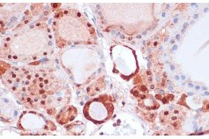 Immunohistochemistry of paraffin-embedded Human thyroid cancer using S100A5 Polyclonal Antibody at dilution of 1:100 (40x lens). (S100A5 Antikörper)
