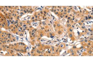 Immunohistochemistry of paraffin-embedded Human lung cancer tissue using AIM2 Polyclonal Antibody at dilution 1:60 (AIM2 Antikörper)