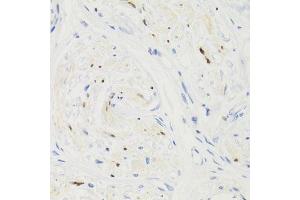 Immunohistochemistry of paraffin-embedded human breast cancer using GEMIN2 Antibody. (SIP1 Antikörper)