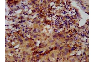 IHC image of ABIN7153231 diluted at 1:400 and staining in paraffin-embedded human ovarian cancer performed on a Leica BondTM system. (FKRP Antikörper  (AA 28-140))