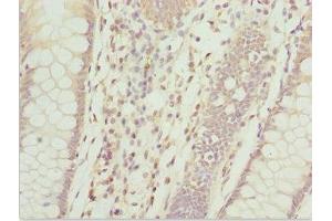 Immunohistochemistry of paraffin-embedded human colon cancer using ABIN7144060 at dilution of 1:100 (ZFAND3 Antikörper  (AA 1-227))