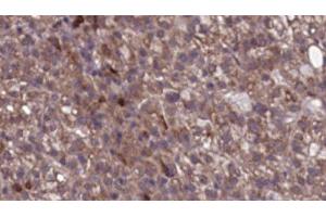 ABIN6276742 at 1/100 staining Human liver cancer tissue by IHC-P. (SCARB1 Antikörper  (Internal Region))