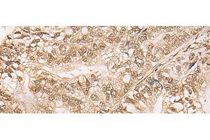 Immunohistochemistry of paraffin-embedded Human gastric cancer tissue using WEE1 Polyclonal Antibody at dilution of 1:35(x200) (WEE1 Antikörper)