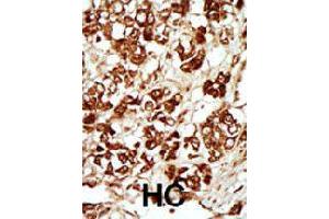 Formalin-fixed and paraffin-embedded human hepatocellular carcinoma tissue reacted with MLKLAK polyclonal antibody  , which was peroxidase-conjugated to the secondary antibody, followed by AEC staining. (ZAK Antikörper  (Internal Region))