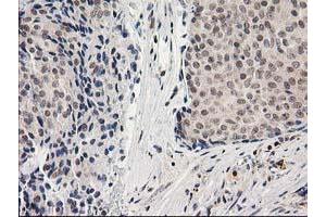 Immunohistochemical staining of paraffin-embedded Adenocarcinoma of Human breast tissue using anti-ADH1B mouse monoclonal antibody. (ADH1B Antikörper)