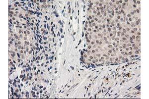 Immunohistochemical staining of paraffin-embedded Adenocarcinoma of Human breast tissue using anti-ADH1B mouse monoclonal antibody.