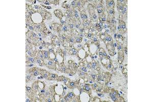 Immunohistochemistry of paraffin-embedded human liver injury using GFPT1 antibody. (GFPT1 Antikörper  (AA 1-150))