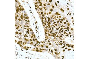 Immunohistochemistry of paraffin-embedded human esophageal cancer using DNA-PKcs Rabbit mAb (ABIN7269665) at dilution of 1:100 (40x lens). (PRKDC Antikörper)