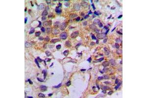 Immunohistochemical analysis of Cathepsin Z staining in human breast cancer formalin fixed paraffin embedded tissue section. (Cathepsin Z Antikörper  (Center))