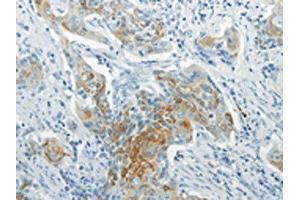 The image on the left is immunohistochemistry of paraffin-embedded Human cervical cancer tissue using ABIN7193069(WNT8B Antibody) at dilution 1/20, on the right is treated with synthetic peptide. (WNT8B Antikörper)