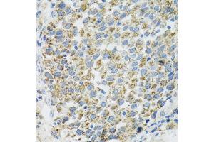 Immunohistochemistry of paraffin-embedded human lung cancer using TXN2 antibody (ABIN5974110) at dilution of 1/100 (40x lens).