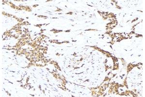 ABIN6275697 at 1/100 staining Human lung cancer tissue by IHC-P. (SLC30A4 Antikörper  (Internal Region))