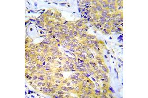 Immunohistochemical analysis of paraffin- embedded human lung adenocarcinoma tissue using CrkL (Ab-207) Antibody (E022071). (CrkL Antikörper)