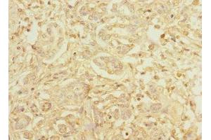 Immunohistochemistry of paraffin-embedded human pancreatic cancer using ABIN7155071 at dilution of 1:100 (Hephaestin Antikörper  (AA 300-580))