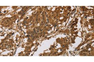 Immunohistochemistry of paraffin-embedded Human gastric cancer tissue using IL19 Polyclonal Antibody at dilution 1:40 (IL-19 Antikörper)