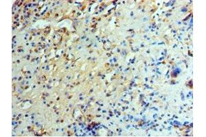 Immunohistochemistry of paraffin-embedded human prostate cancer using ABIN7151466 at dilution of 1:100 (GCN2 Antikörper  (AA 1-300))