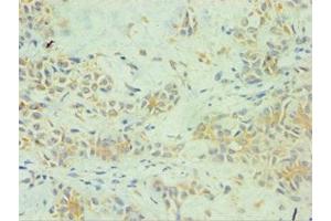 Immunohistochemistry of paraffin-embedded human breast cancer using ABIN7157738 at dilution of 1:100 (SPINT1 Antikörper  (AA 250-529))