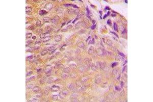 Immunohistochemical analysis of GRB10 staining in human breast cancer formalin fixed paraffin embedded tissue section. (GRB10 Antikörper  (N-Term))