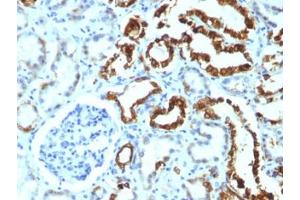 FFPE human renal cell carcinoma tested with MFGE8 antibody (MFG-06) (MFGE8 Antikörper)