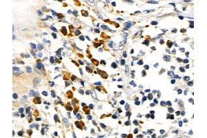 Phospho-RUNX2 (Ser319) Antibody at 1/100 staining Human lung cancer by IHC-P. (RUNX2 Antikörper  (pSer319))