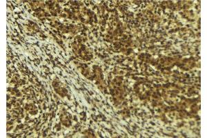 ABIN6273995 at 1/100 staining Human breast cancer tissue by IHC-P. (BRD4 Antikörper  (N-Term))