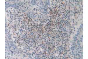 IHC-P analysis of Human Skin Cancer Tissue, with DAB staining. (FDFT1 Antikörper  (AA 269-417))