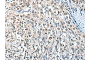 The image on the left is immunohistochemistry of paraffin-embedded Human esophagus cancer tissue using ABIN7128286(AGBL3 Antibody) at dilution 1/25, on the right is treated with fusion protein. (AGBL3 Antikörper)
