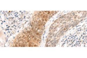 Immunohistochemistry of paraffin-embedded Human esophagus cancer tissue using GHDC Polyclonal Antibody at dilution of 1:90(x200) (GHDC Antikörper)
