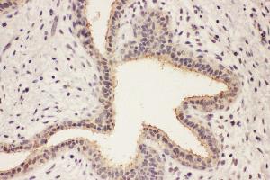 Anti-RAB8A antibody, IHC(P) IHC(P): Human Mammary Cancer Tissue