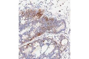 Immunohistochemical analysis of paraffin-embedded Human colon carcinoma tissue using (ABIN389547 and ABIN2839591) performed on the Leica® BOND RXm. (CREB1 Antikörper  (pSer133))