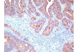 Formalin-fixed, paraffin-embedded human Colon Carcinoma stained with CEA, pan Mouse Monoclonal Antibody (Cocktail) (CEACAM5 Antikörper)