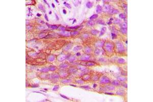 Immunohistochemical analysis of HSL staining in human breast cancer formalin fixed paraffin embedded tissue section. (LIPE Antikörper  (Center))