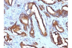 Formalin-fixed, paraffin-embedded human Prostate Carcinoma stained with CD63 Monoclonal Antibody (NKI/C3 + LAMP3/968) (CD63 Antikörper)