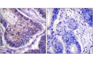 Immunohistochemistry analysis of paraffin-embedded human colon carcinoma tissue, using eIF4B (Ab-422) Antibody. (EIF4B Antikörper  (AA 388-437))
